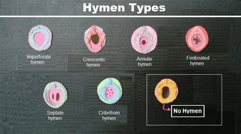 hymen pictures|Category : Hymen